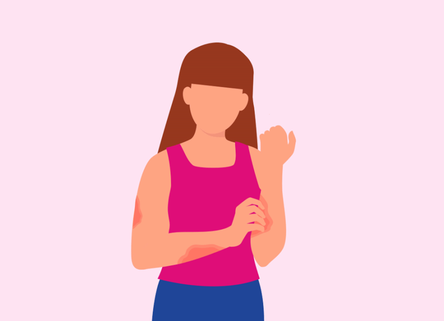 illustration of woman with atopic dermatitis