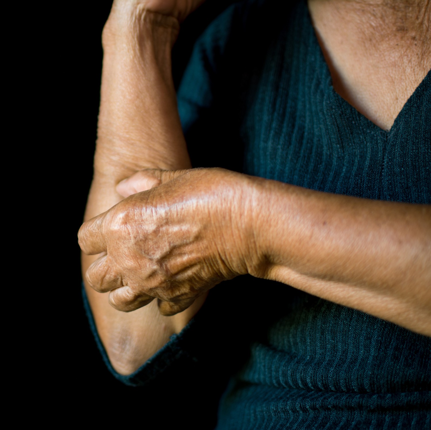 Photo of older woman with atopic dermatitis or psoriasis